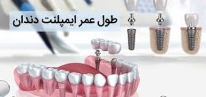 طول عمرایمپلنت دندان | کارت تخفیف دندانپزشکی بنیان مهام