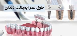 طول عمرایمپلنت دندان | کارت تخفیف دندانپزشکی بنیان مهام